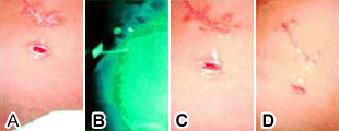 急性虫垂炎術後廔孔のオゾン化油（2000年）による治療の治療前・治療後